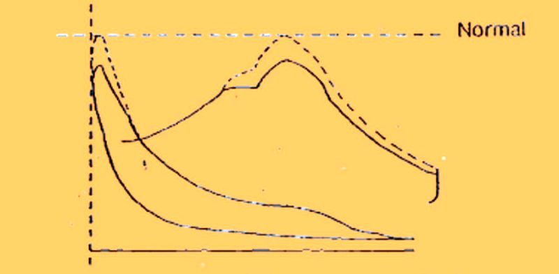 Both Maximum Pressure and Compression Pressure are Low