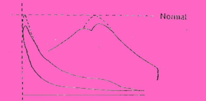 Maximum Pressure Too Low, but Compression Pressure is Normal